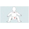 ortesi-per-abduzione-danca-per-bambini-ottobock-tubingen-28l10