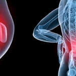 Osteoartrite: Sintomi, Cause e Possibili Cure