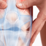 Versamento Articolare Recidivante: Cause, Sintomi e Trattamenti Efficaci