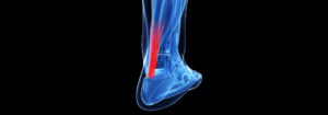Stati Infiammatori Dopo Fratture del Tendine di Achille