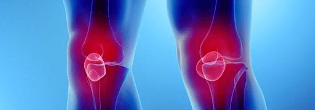 Sindrome dell'Apice Rotuleo