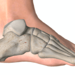 Achillodinia e Sindrome di Haglund: Cause, Trattamento e Recupero