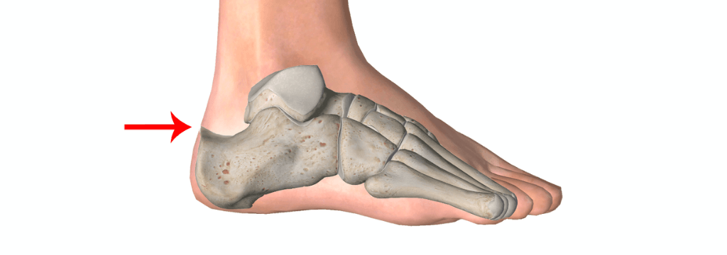 Achillodinia e Sindrome di Haglund