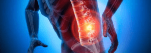 Sindrome Lombalgica Acuta