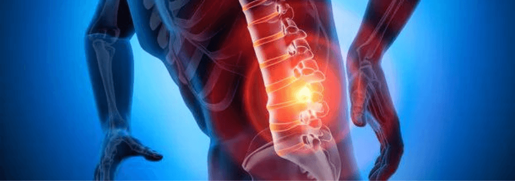 Sindrome Lombalgica Acuta