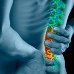 Stati Dolori nella Zona Lombare: Moderata Lombosciatalgia con Prolasso del Disco Intervertebrale