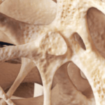 Osteoporosi: Guida Essenziale per la Prevenzione e la Gestione della Salute Ossea