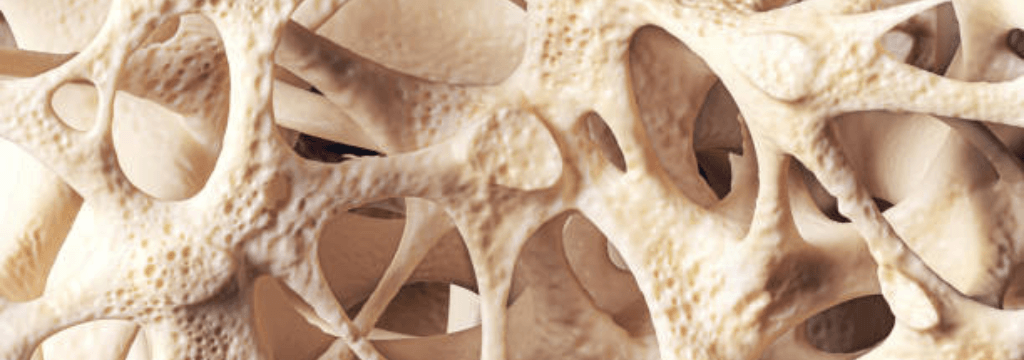 Osteoporosi e fratture vertebrali