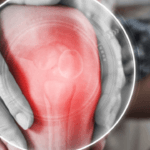 Comprendere le Lesioni ai Legamenti Crociati: Cause, Sintomi e Recupero