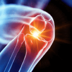 Gonartrosi: Capire la Malattia e Come Gestire la Gonartrosi Grave