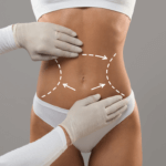 Liposuzione Addominale: Rimodellare l’Addome per un Aspetto Tonico e Definito