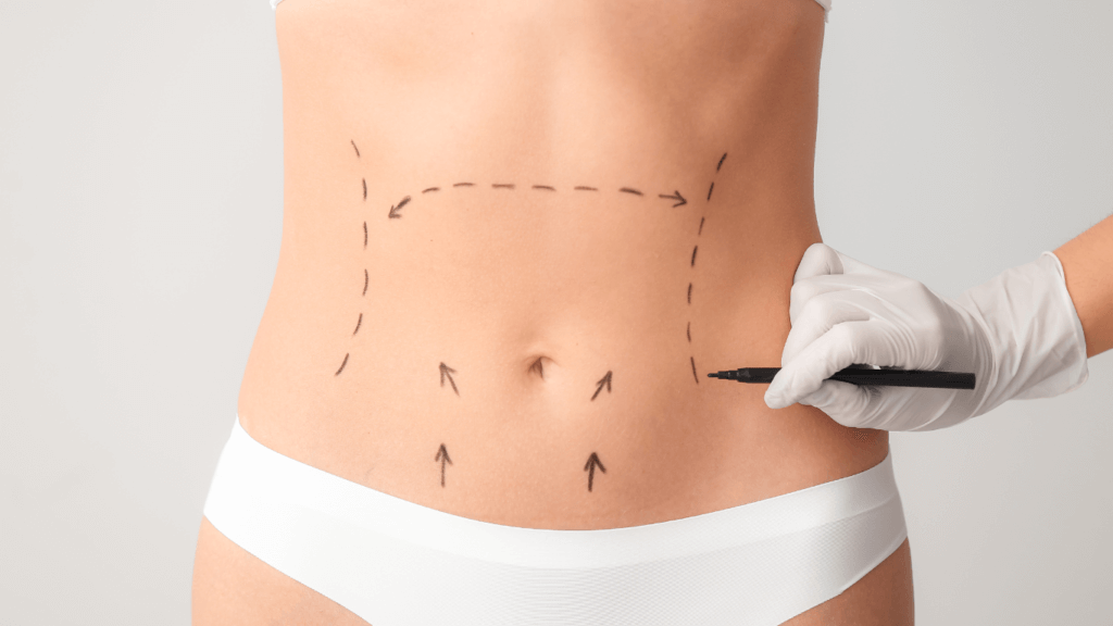 Addominoplastica: Rimodellare l'Addome per un Aspetto Tonico e Definito