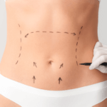 Addominoplastica: Rimodellare l’Addome per un Aspetto Tonico e Definito