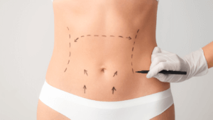 Addominoplastica: Rimodellare l'Addome per un Aspetto Tonico e Definito