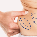 Guaina Dopo Liposuzione e Addominoplastica: Quale Scegliere e Quanto Tenerla