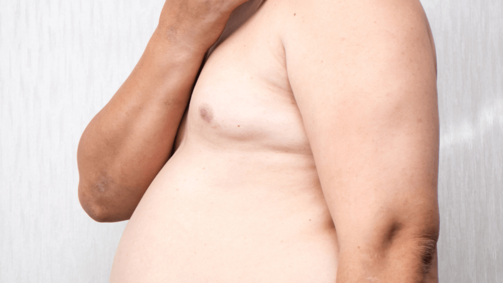Ginecomastia