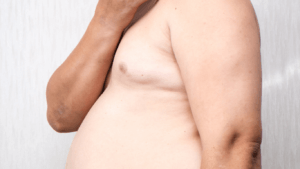 Ginecomastia